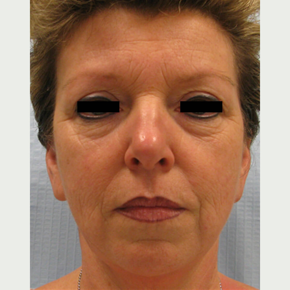 Low-Full-Face-Rejuvenation-004 Before