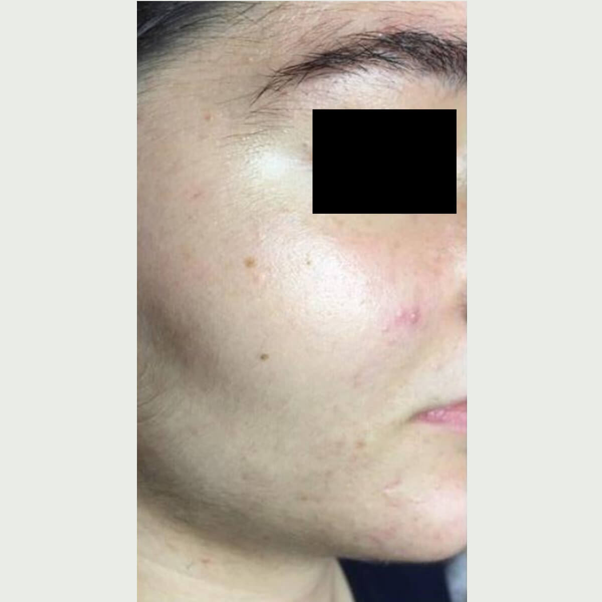 Mid-Acne-010 after