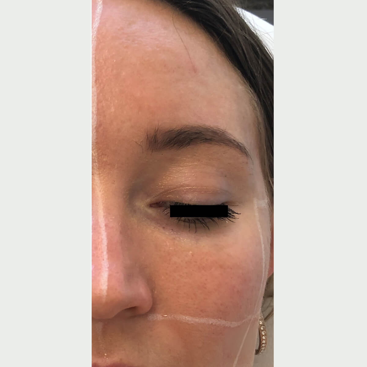 Mid-Melasma-021 AFTER