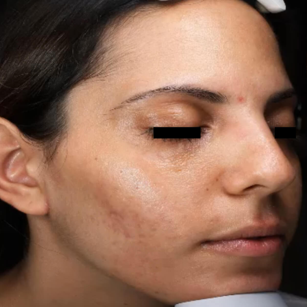 Top-Acne-030 AFTER