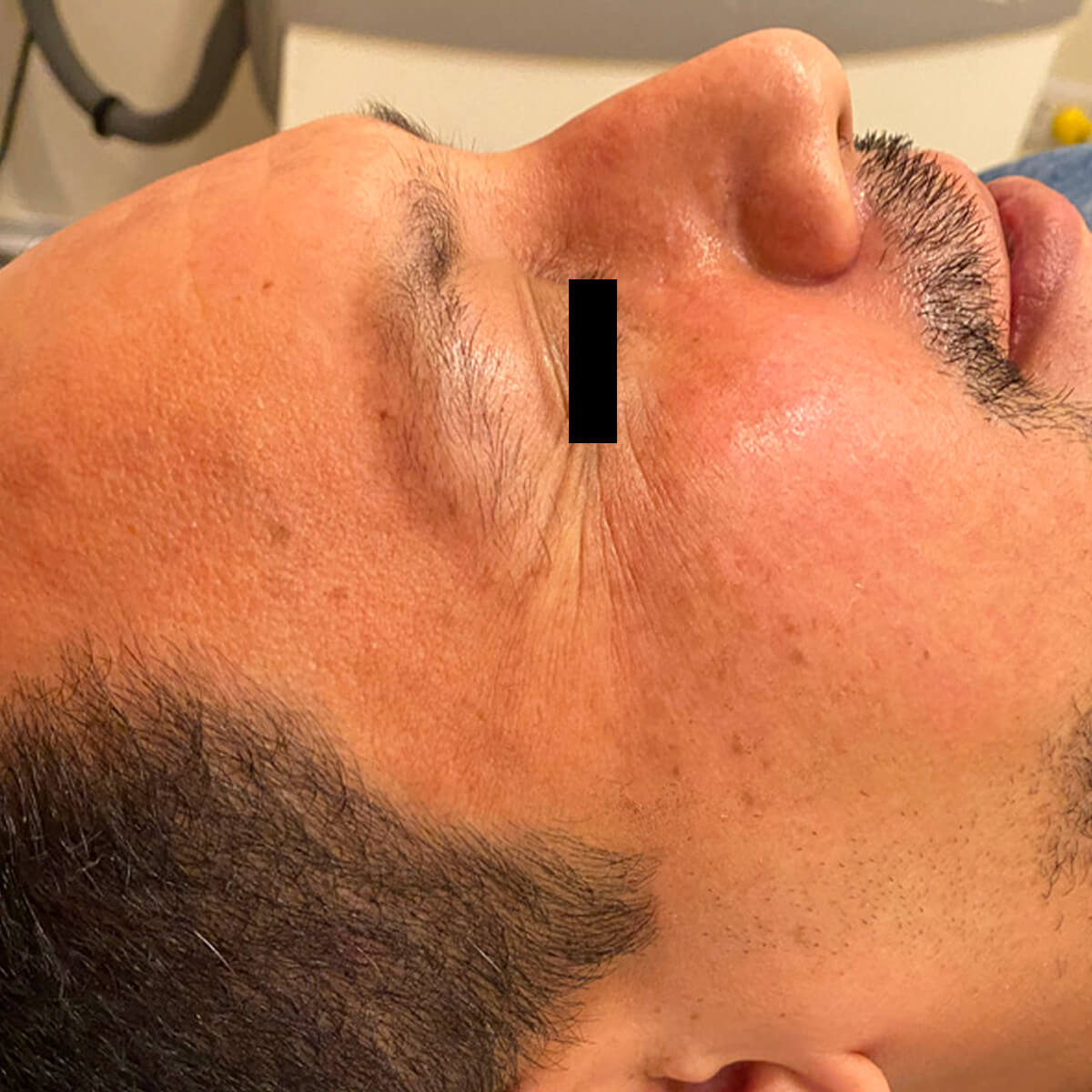 Top-Melasma-040 AFTER