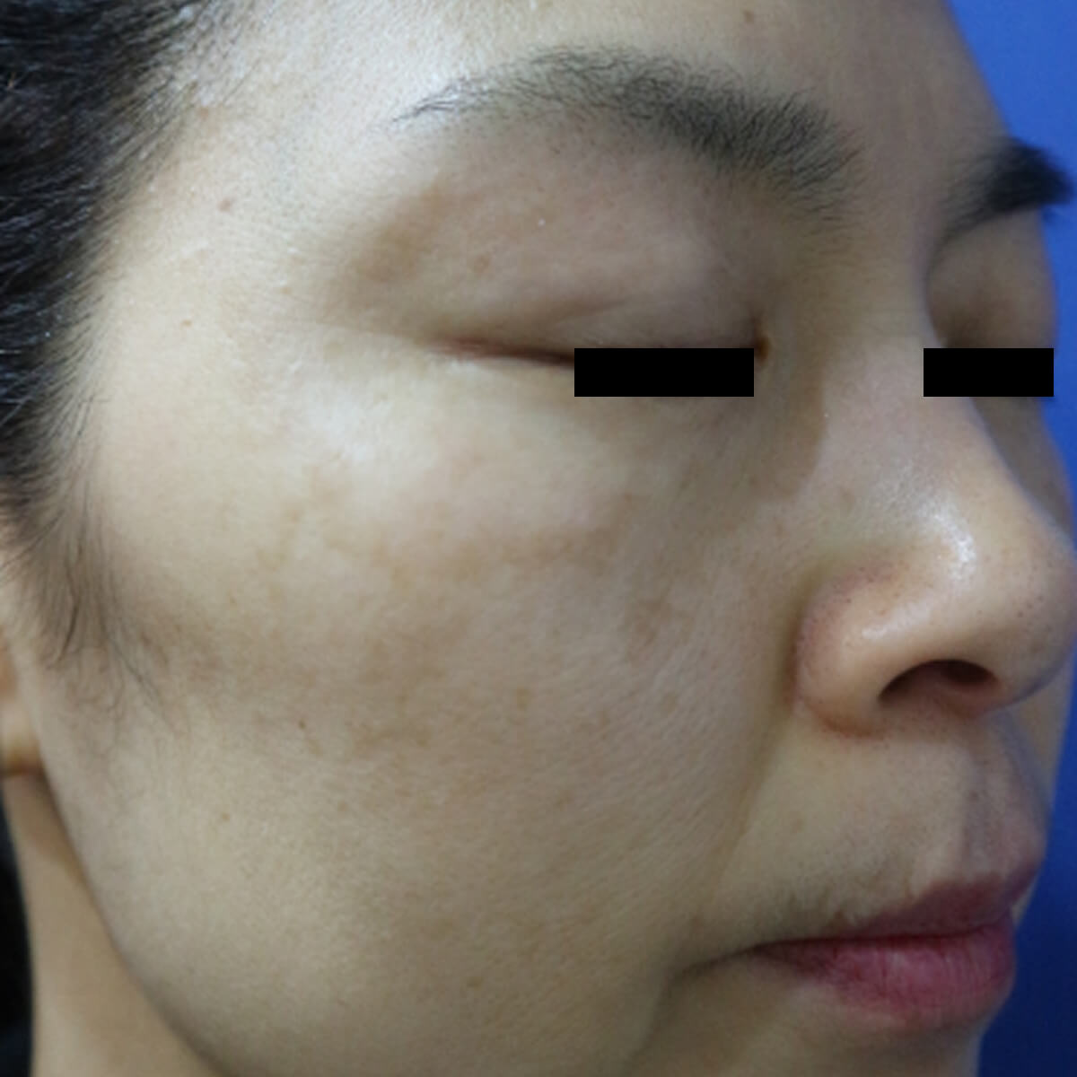 Top-Melasma-043 AFTER