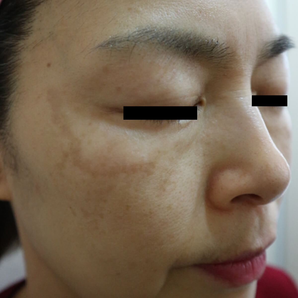 Top-Melasma-043 Before