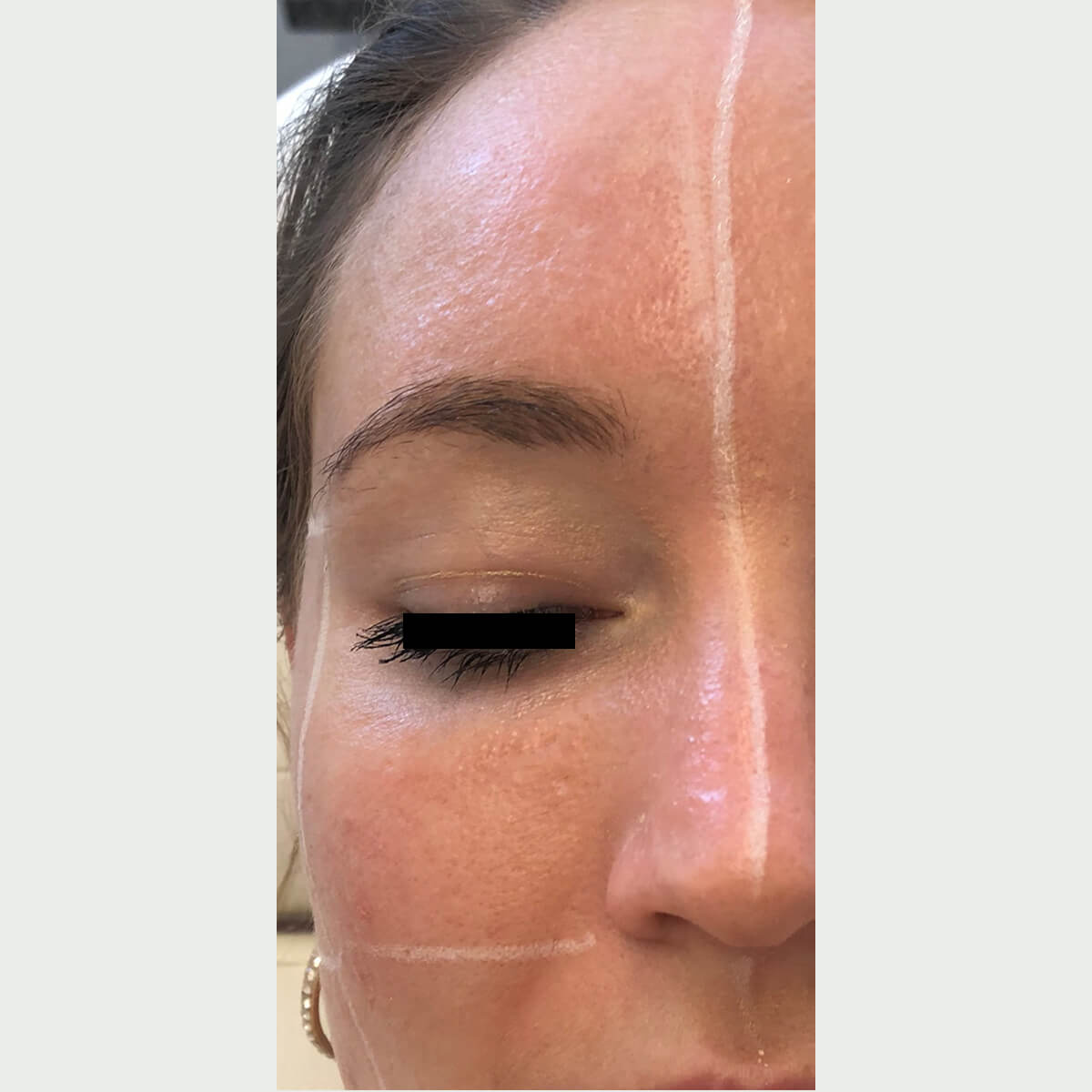 Top-Melasma-045 AFTER